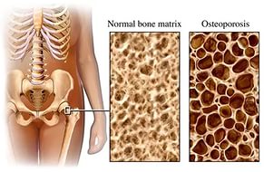 Сравнение нормальной кости и поражённой остеопорозом