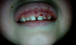 Травмирование зубов