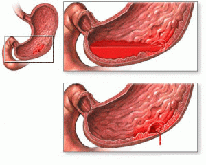 Механизмы возникновения и разновидности желудочно-кишечных кровотечений