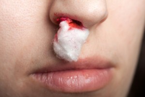 Оказание первой помощи при возникновении носового кровотечения