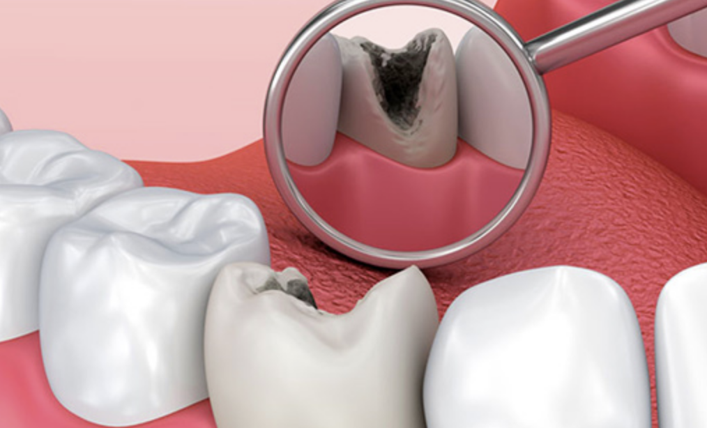 Что такое кариес зубов?